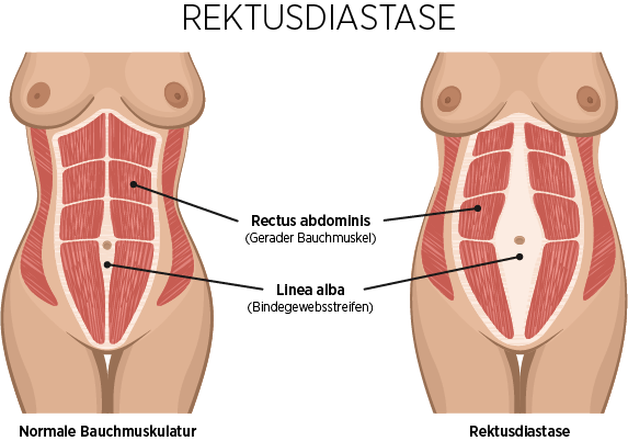 ICE AESHTETIC® - Rektusdiastase vs. Normalabdomen - Cristal Fit® - Rektusdiastase